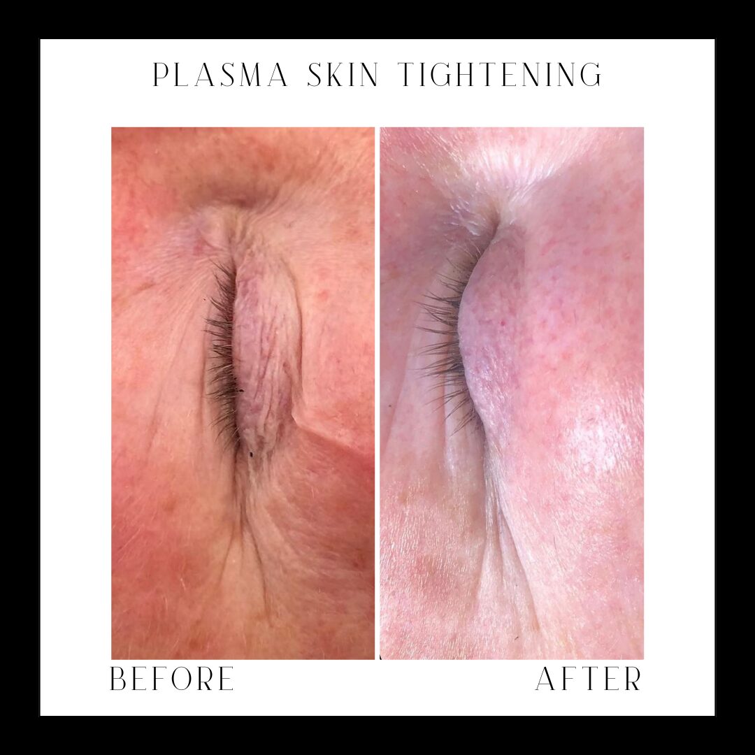 Comparison of skin around an eye before and after plasma skin tightening treatment, showing smoother skin after.