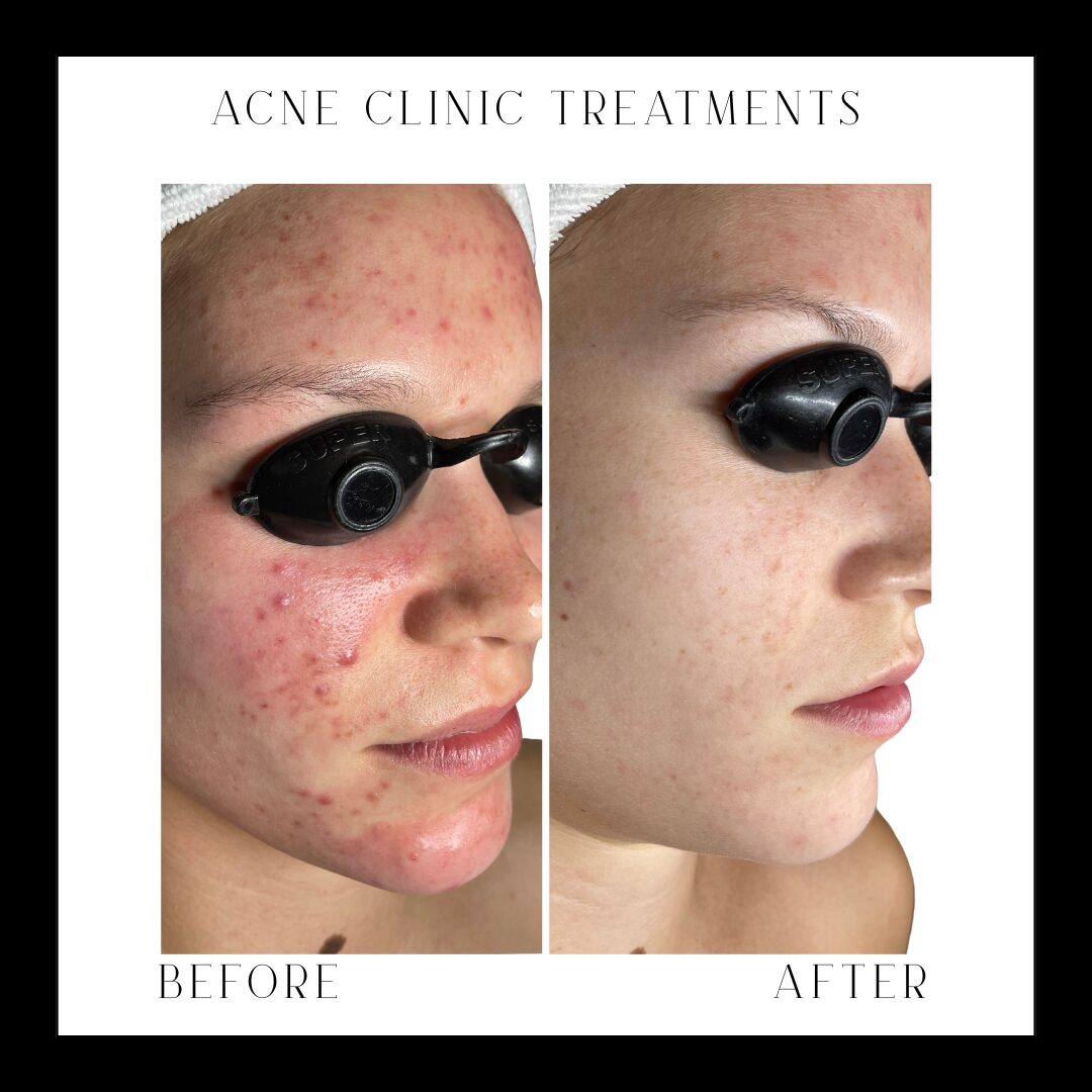 Side-by-side comparison of a person's face showing acne before and clear skin after treatment, with text labels.