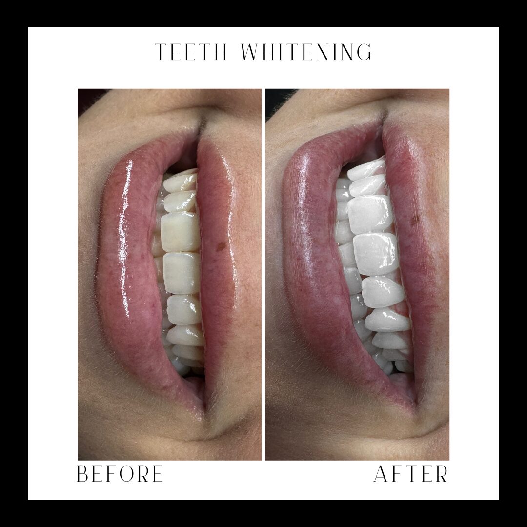 Comparison of teeth whitening results, showing a person's open mouth before and after treatment, with visible teeth and lips, on a white background.