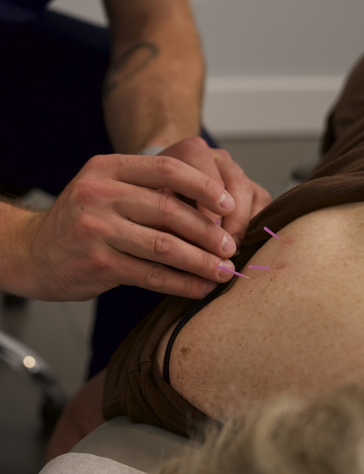 Person receiving acupuncture treatment on their back, with practitioner inserting a needle, in a clinical setting.