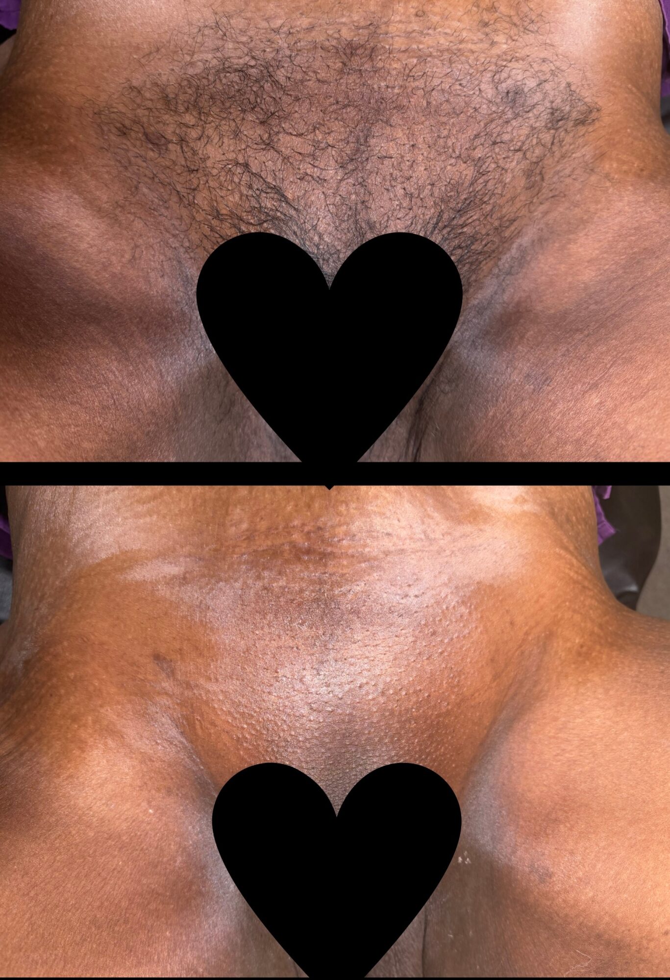 Close-up of a person's chest showing hair and skin, with a black heart shape covering the nipple area.
