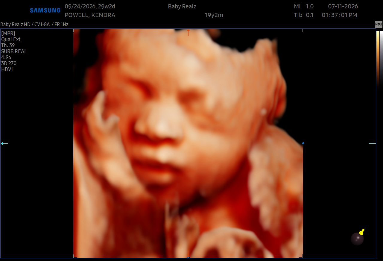 Fetal face with closed eyes and nose visible in ultrasound image, showing detailed facial features.