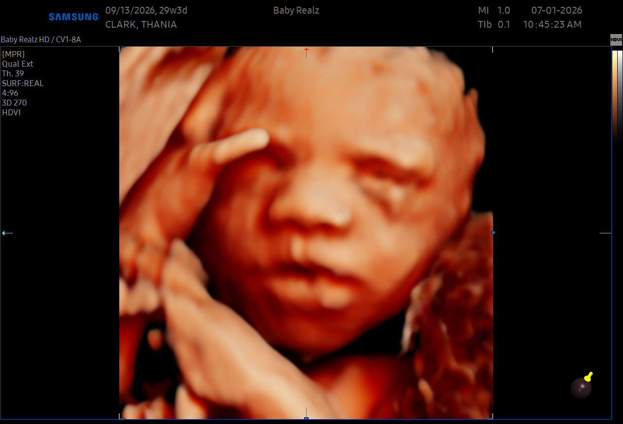 Fetal ultrasound image showing a detailed face with closed eyes and hand near the forehead.