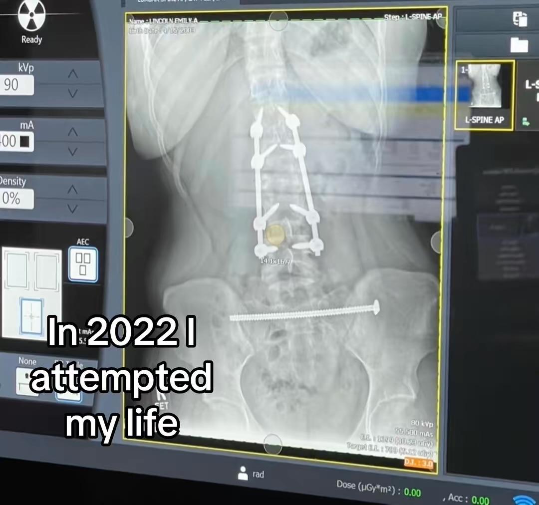 X-ray image of a pelvis with metal implants and a rod, with text overlay reading 'In 2022 I attempted my life'.