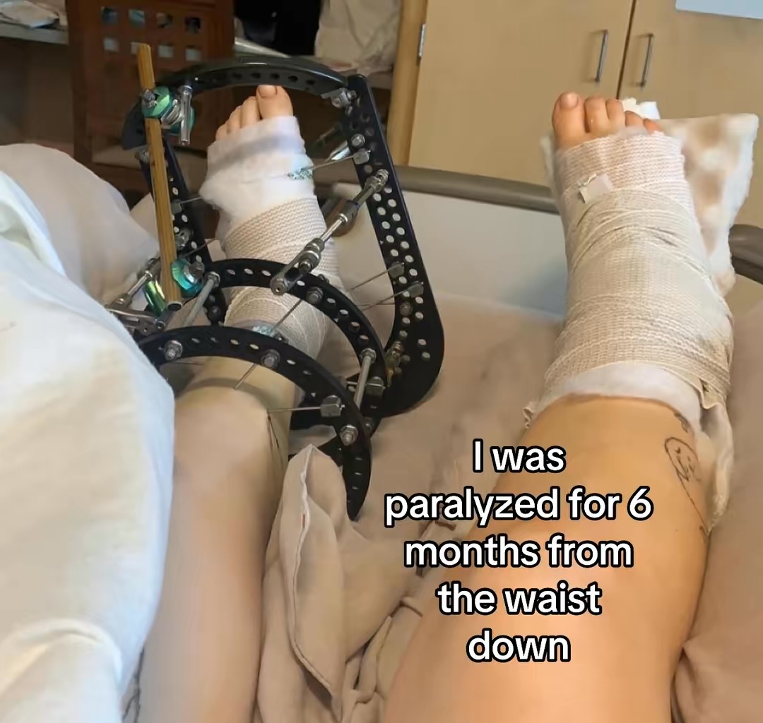 Person with leg in a cast and brace, lying in bed, with text about paralysis for six months.