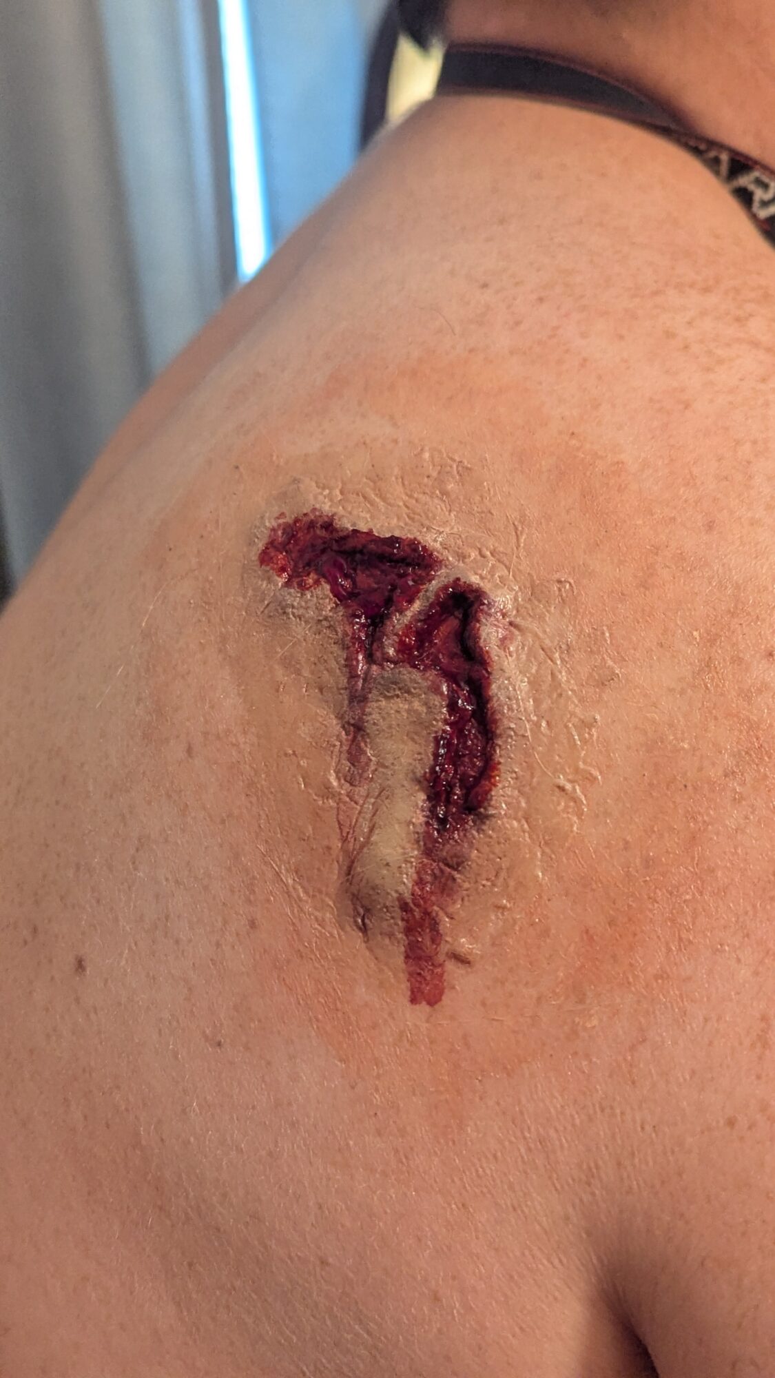 Close-up of a healing skin wound with scabbing and redness on a person's shoulder.
