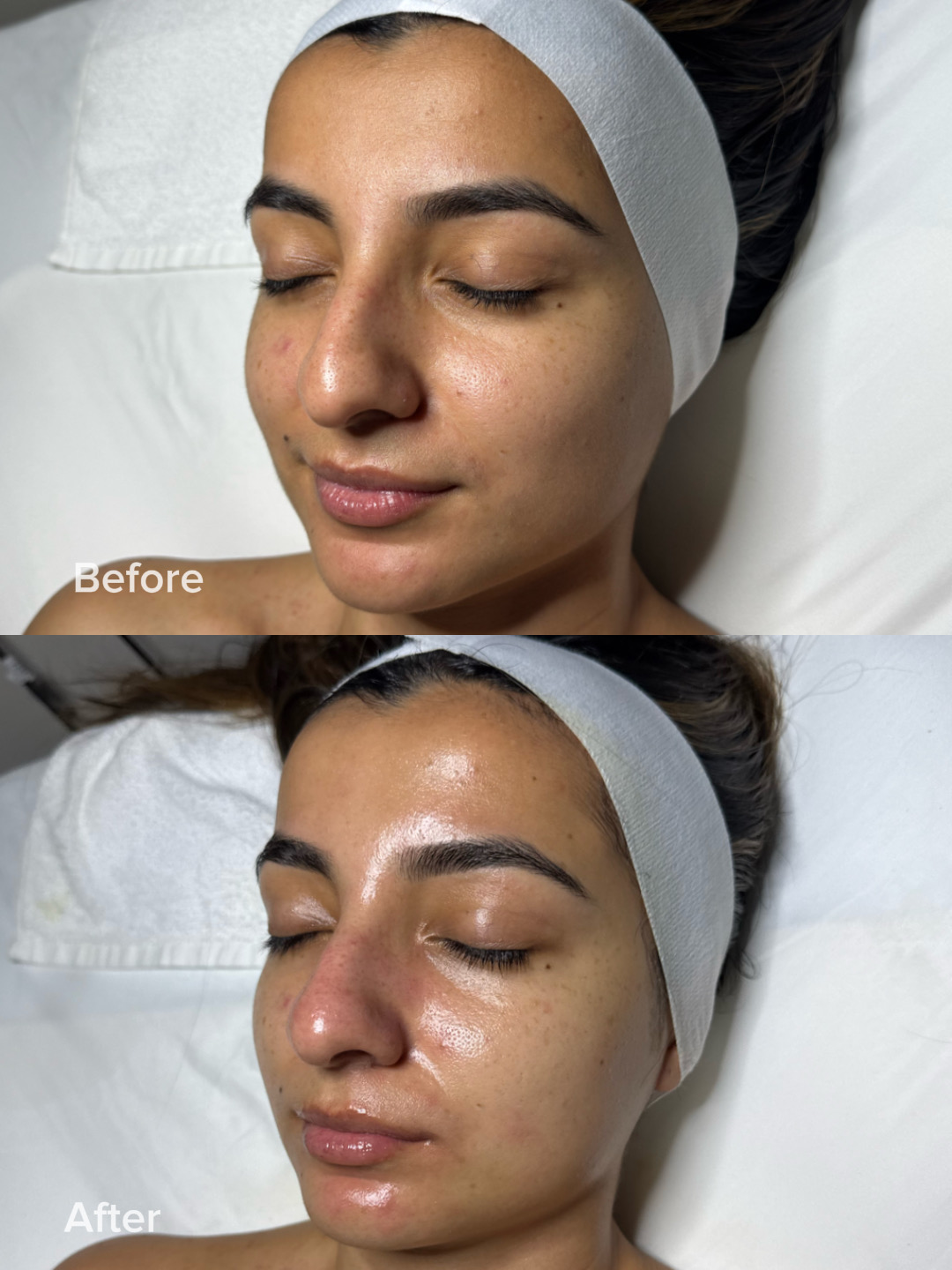 Side-by-side comparison of a woman before and after skincare treatment, with eyes closed, wearing a headband, lying down.