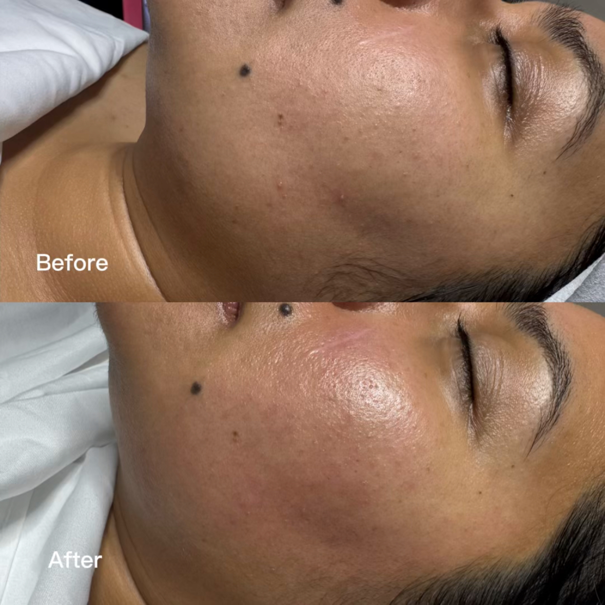 Close-up of a person's face showing skin improvement after treatment, with visible reduction in acne scars and smoother skin.